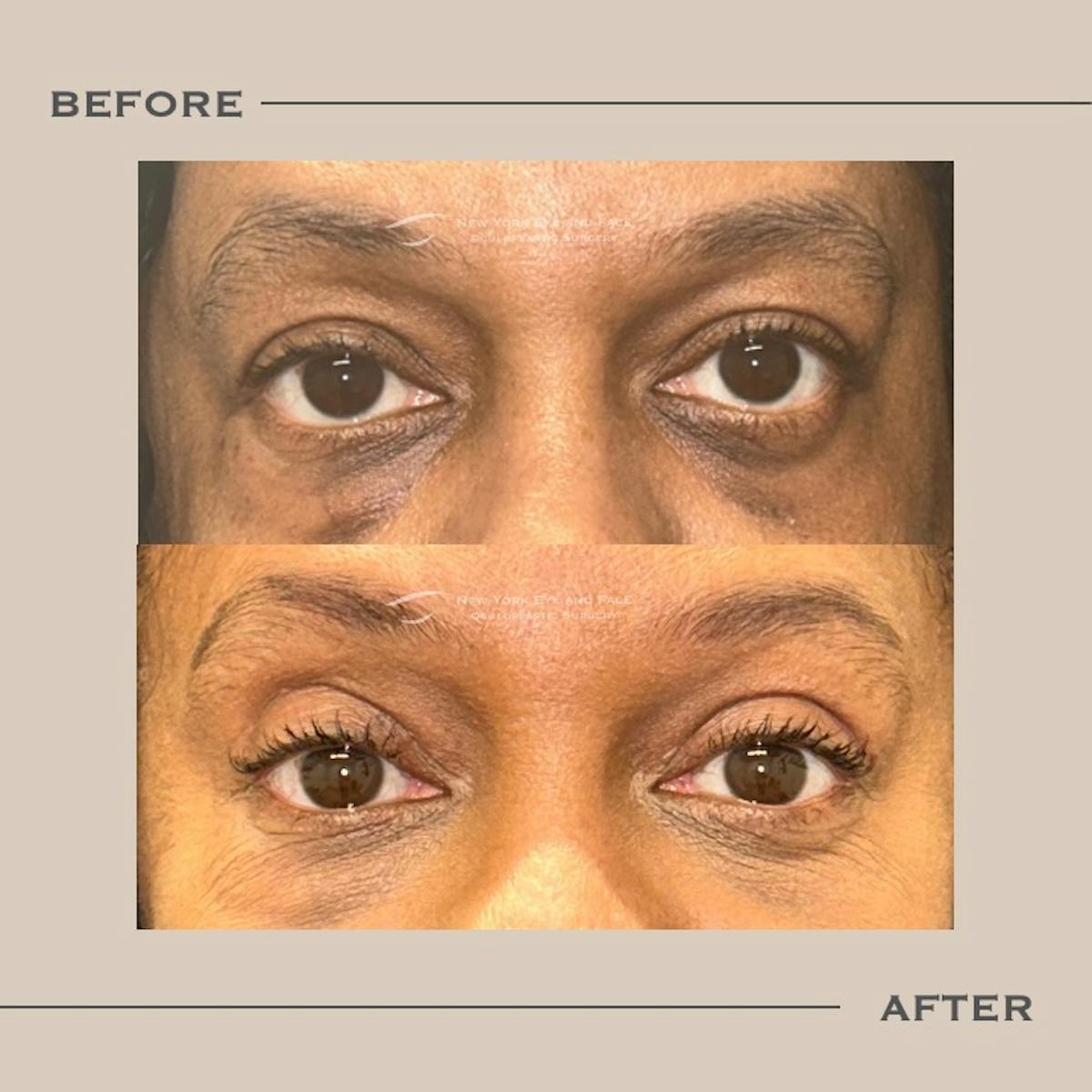 Brow Lift Before & After Gallery - Patient 343418 - Image 1