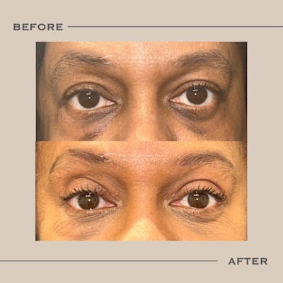 Upper Blepharoplasty Before & After Gallery - Patient 415870 - Image 1