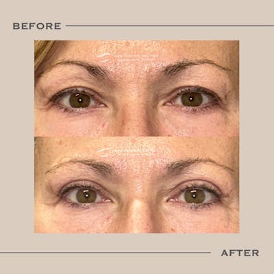 Upper Blepharoplasty Before & After Gallery - Patient 172025 - Image 1