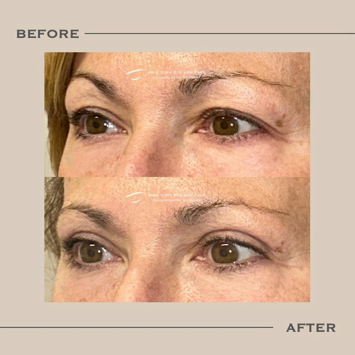 Upper Blepharoplasty Before & After Gallery - Patient 172025 - Image 3