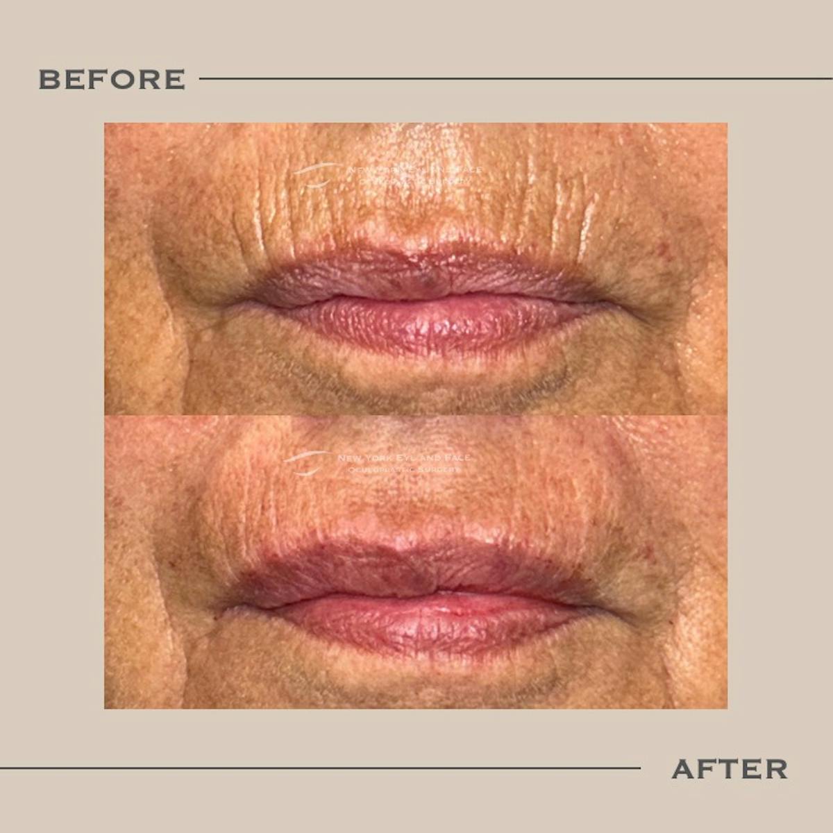 Lip Fillers Before & After Gallery - Patient 198021 - Image 1