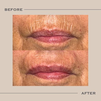 Lip Fillers Before & After Gallery - Patient 198021 - Image 1
