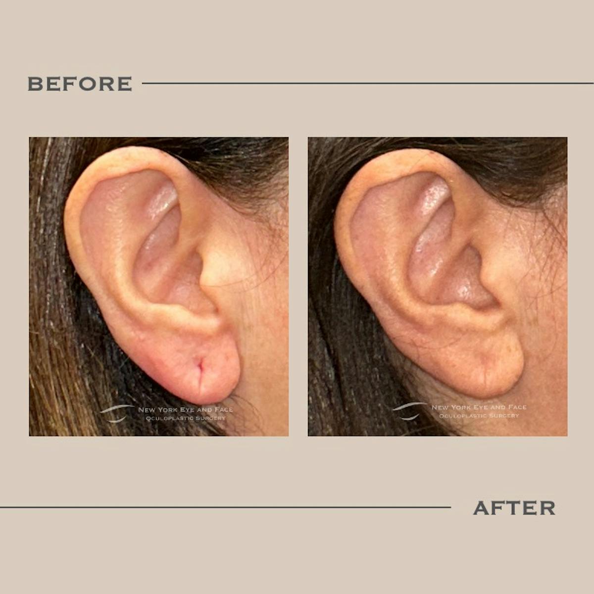 Earlobe Repair Before & After Gallery - Patient 760874 - Image 1