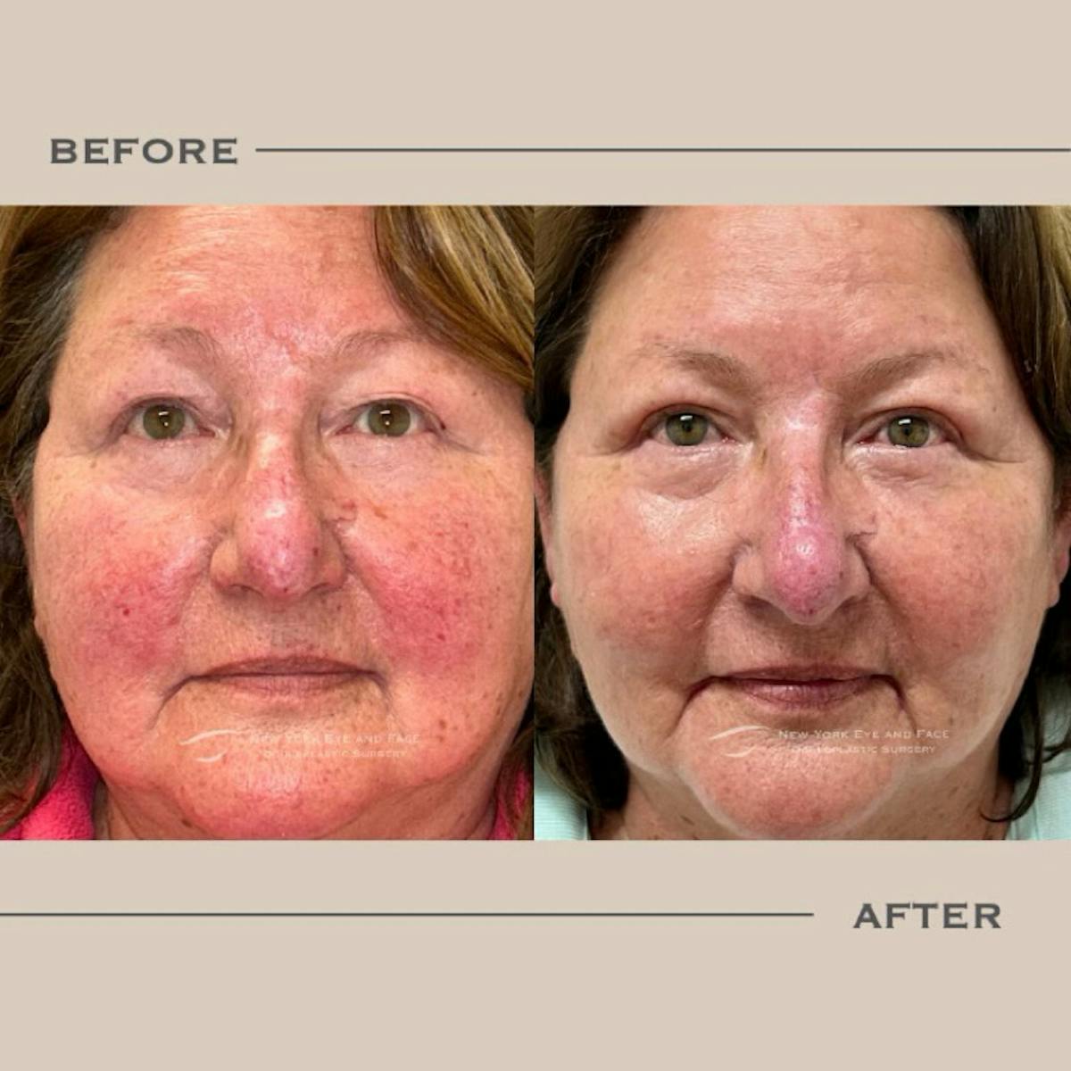 BroadBand Light (BBL) Before & After Gallery - Patient 124623 - Image 1