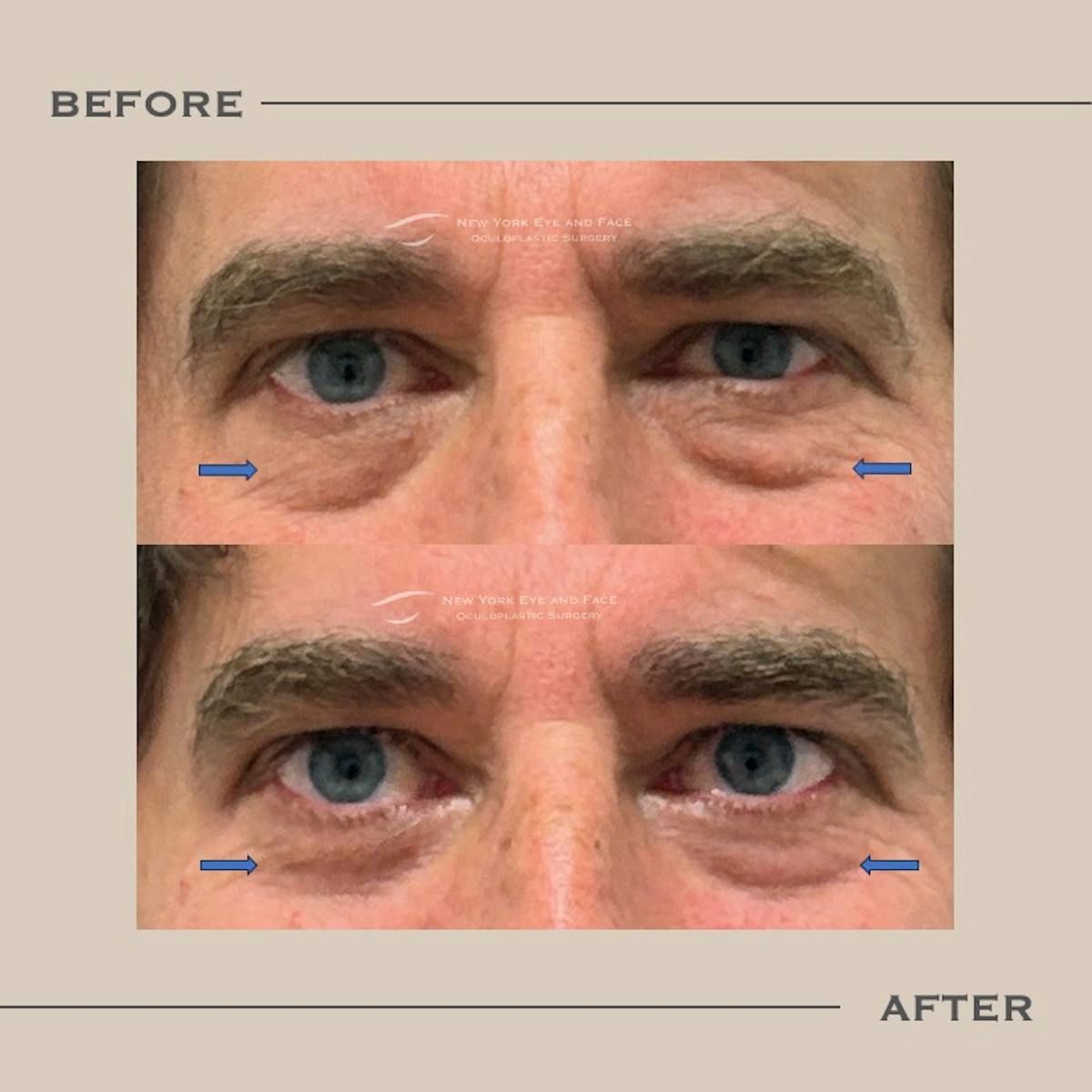 Male Blepharoplasty Before & After Gallery - Patient 151216 - Image 1