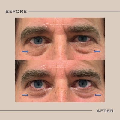 Male Blepharoplasty Before & After Gallery - Patient 151216 - Image 1