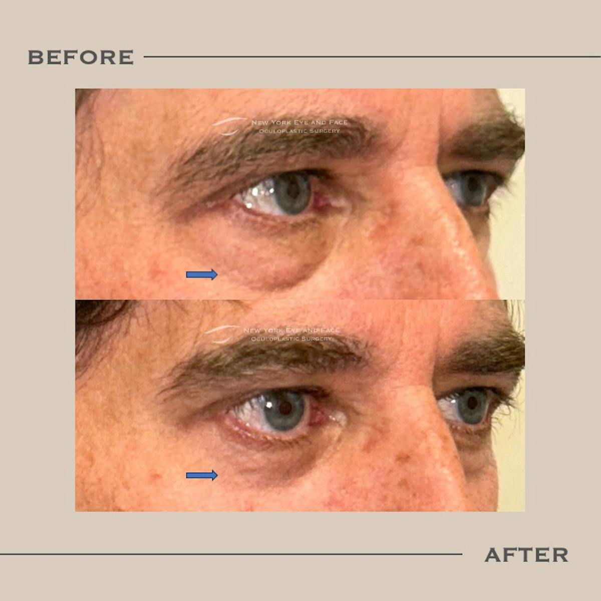 Male Blepharoplasty Before & After Gallery - Patient 151216 - Image 2