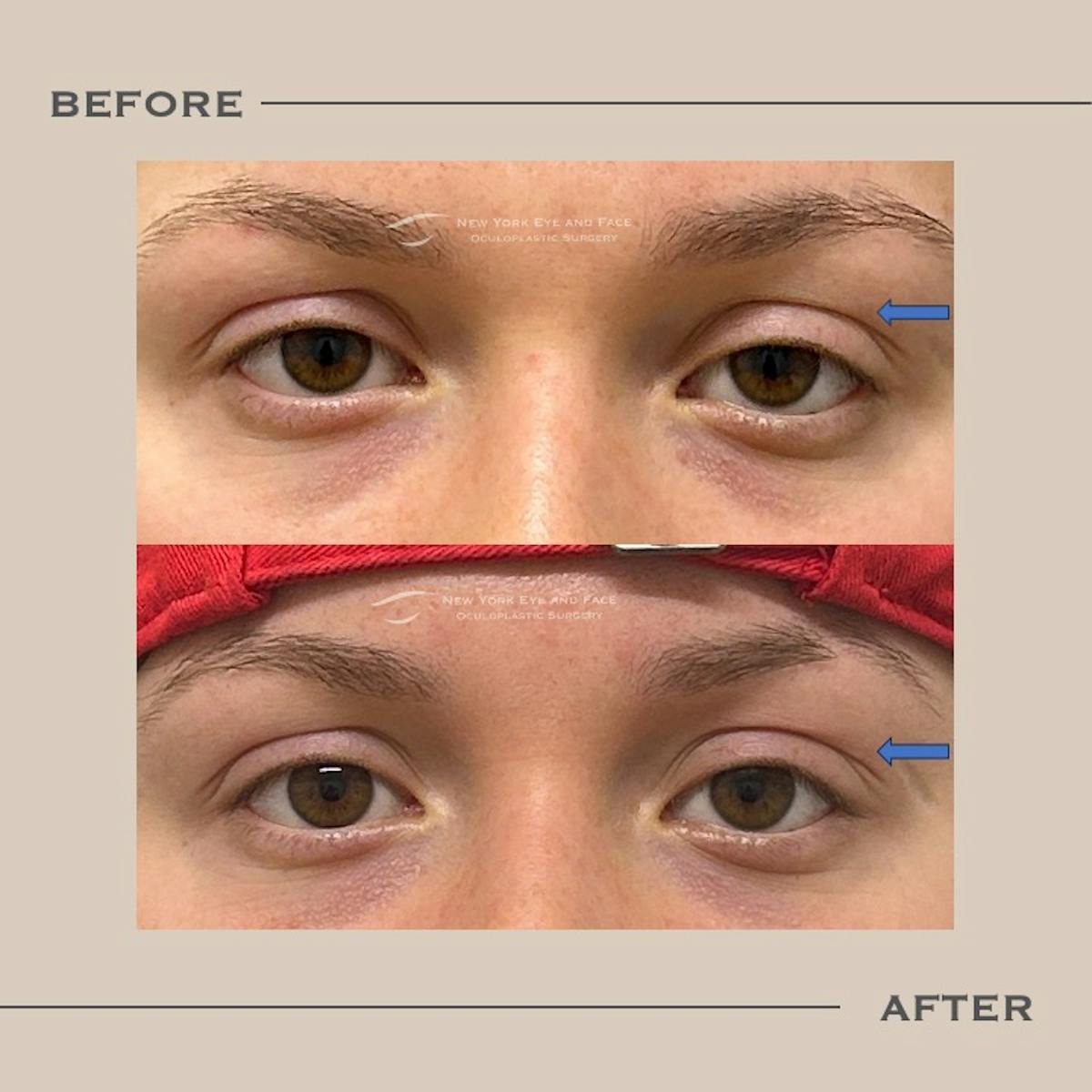 Ptosis  Before & After Gallery - Patient 175887 - Image 1