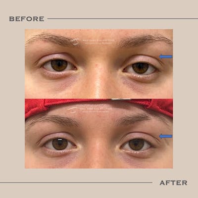 Ptosis  Before & After Gallery - Patient 175887 - Image 1