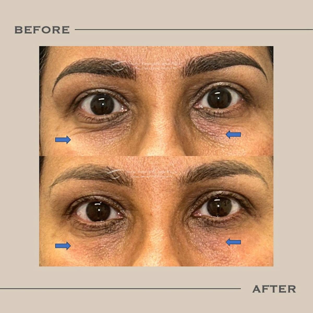 Dermal Fillers Before & After Gallery - Patient 263582 - Image 1