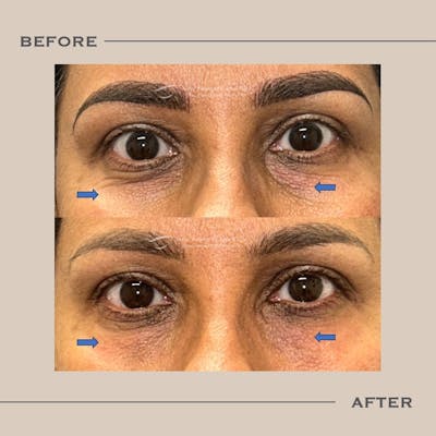 Dermal Fillers Before & After Gallery - Patient 263582 - Image 1