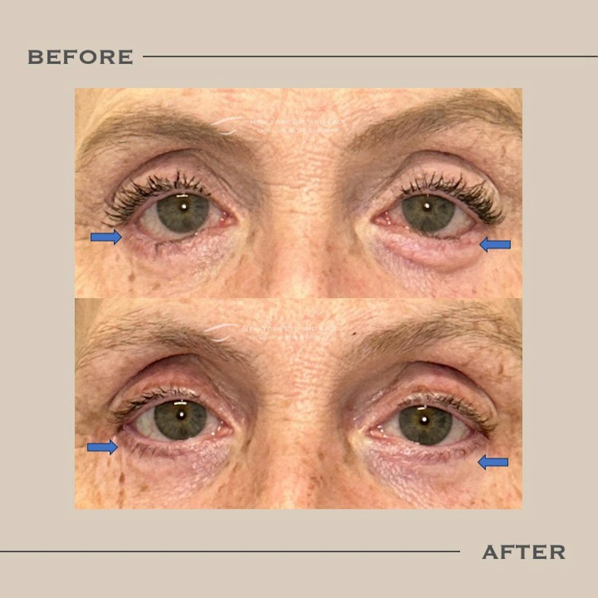 Revision Blepharoplasty Before & After Gallery - Patient 788297 - Image 1