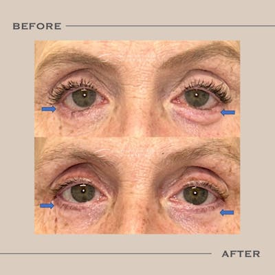 Revision Blepharoplasty Before & After Gallery - Patient 788297 - Image 1