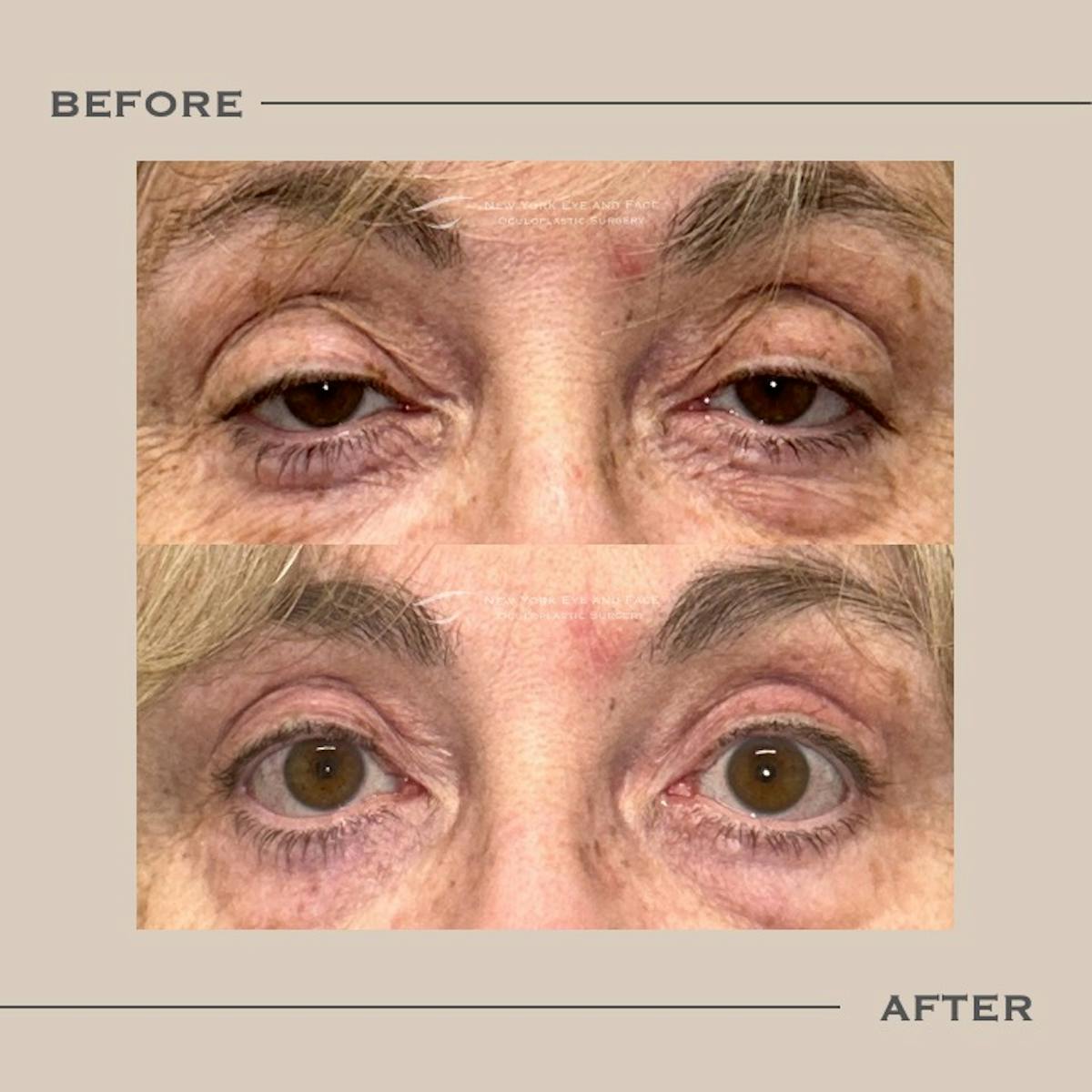 Ptosis  Before & After Gallery - Patient 141910 - Image 1