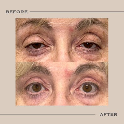 Ptosis  Before & After Gallery - Patient 141910 - Image 1
