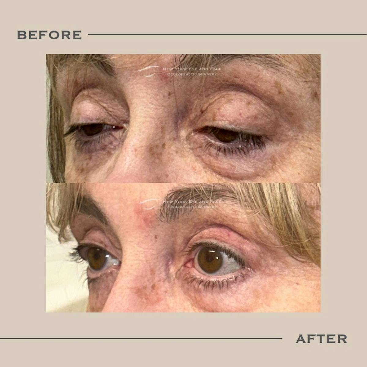 Ptosis  Before & After Gallery - Patient 141910 - Image 3