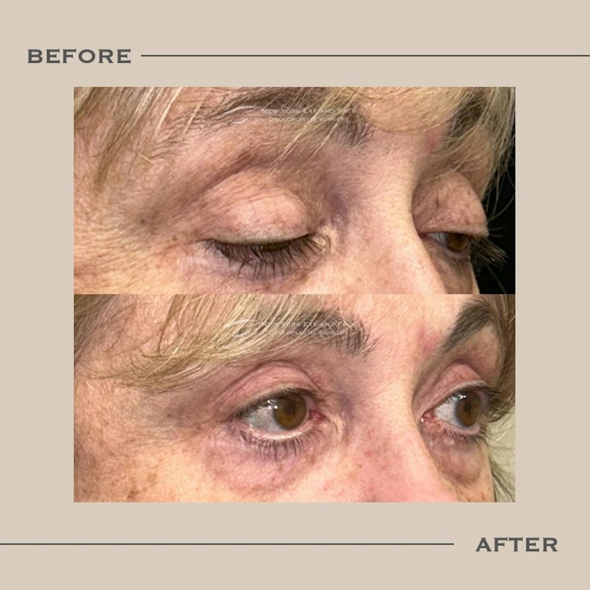 Ptosis  Before & After Gallery - Patient 141910 - Image 2