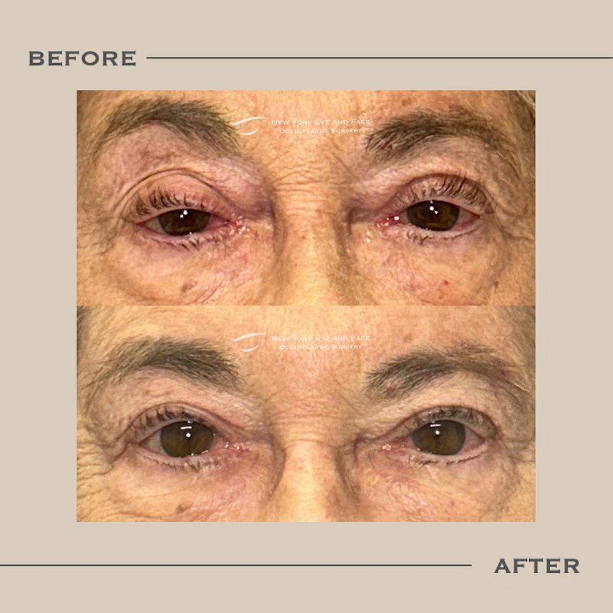 Ptosis  Before & After Gallery - Patient 376933 - Image 1