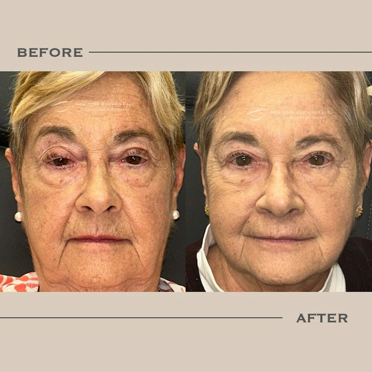Ptosis  Before & After Gallery - Patient 376933 - Image 2