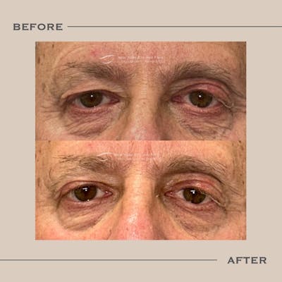 Male Blepharoplasty Before & After Gallery - Patient 940484 - Image 1