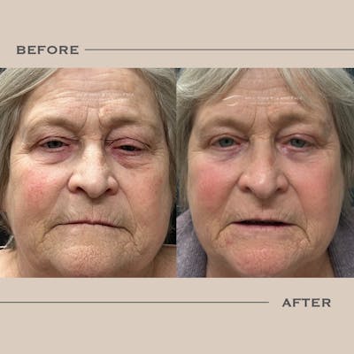 AcuPulse CO2 Laser Before & After Gallery - Patient 226066 - Image 1