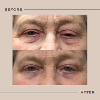Upper Blepharoplasty Before & After Gallery - Patient 291514 - Image 1