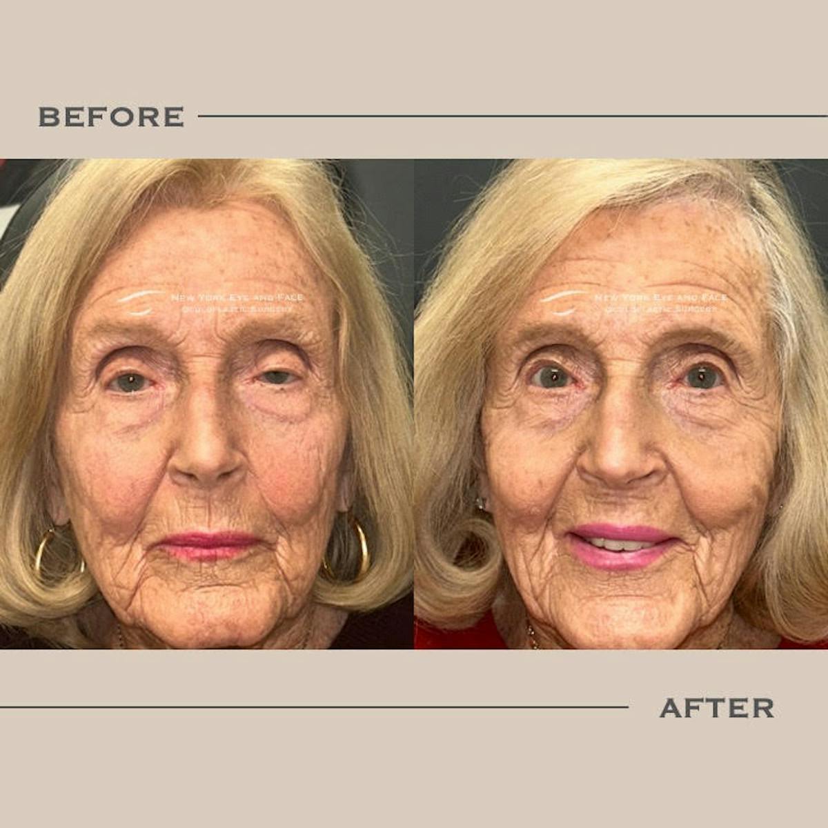 Ptosis  Before & After Gallery - Patient 157526 - Image 1