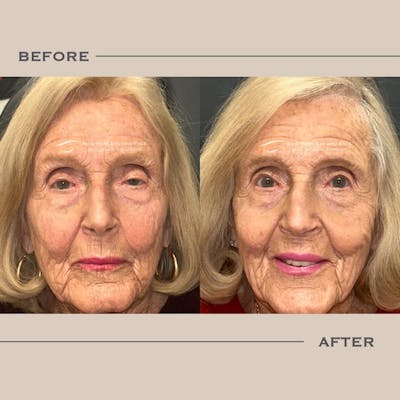 Ptosis  Before & After Gallery - Patient 157526 - Image 1