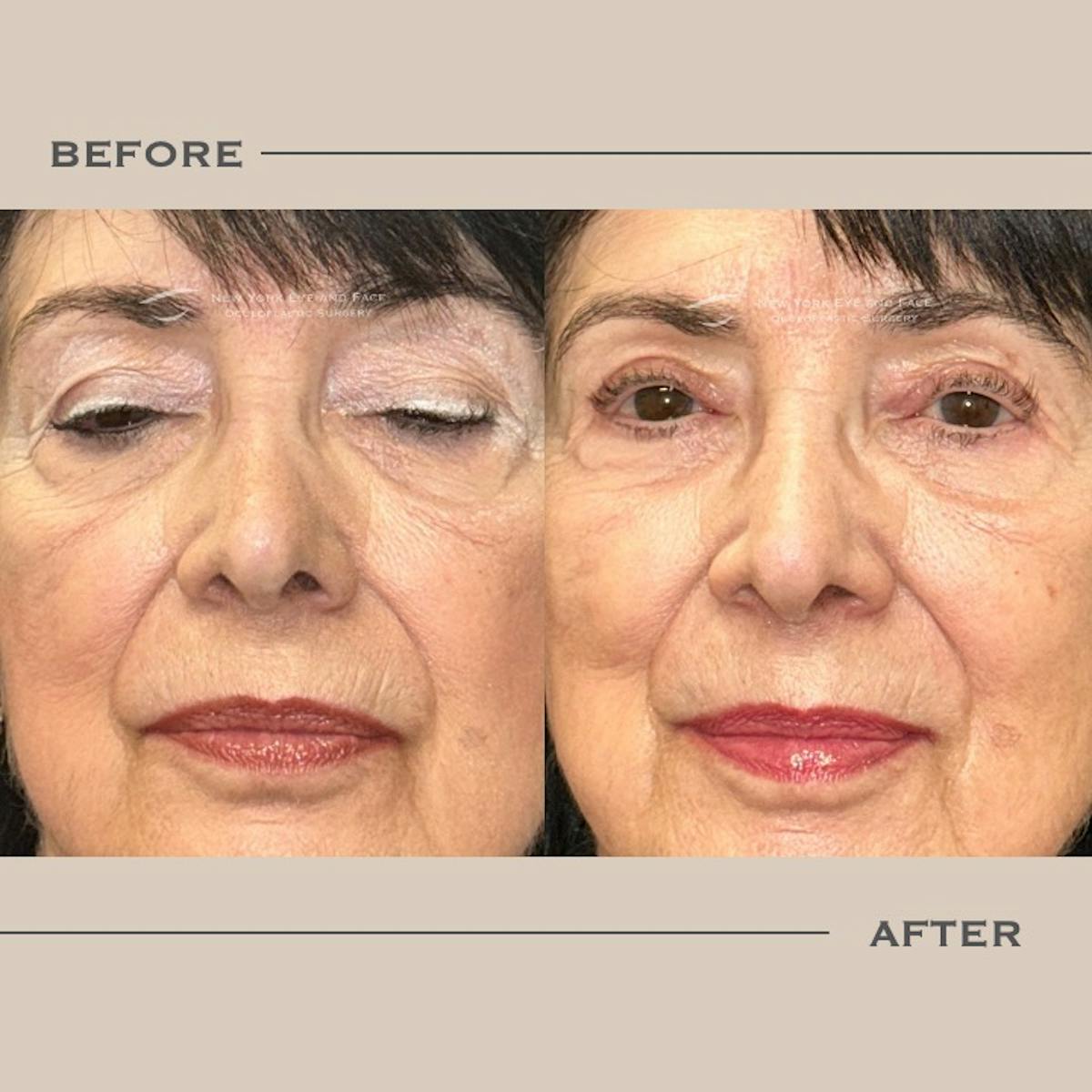 Ptosis  Before & After Gallery - Patient 181159 - Image 2