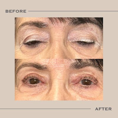 Ptosis  Before & After Gallery - Patient 181159 - Image 1