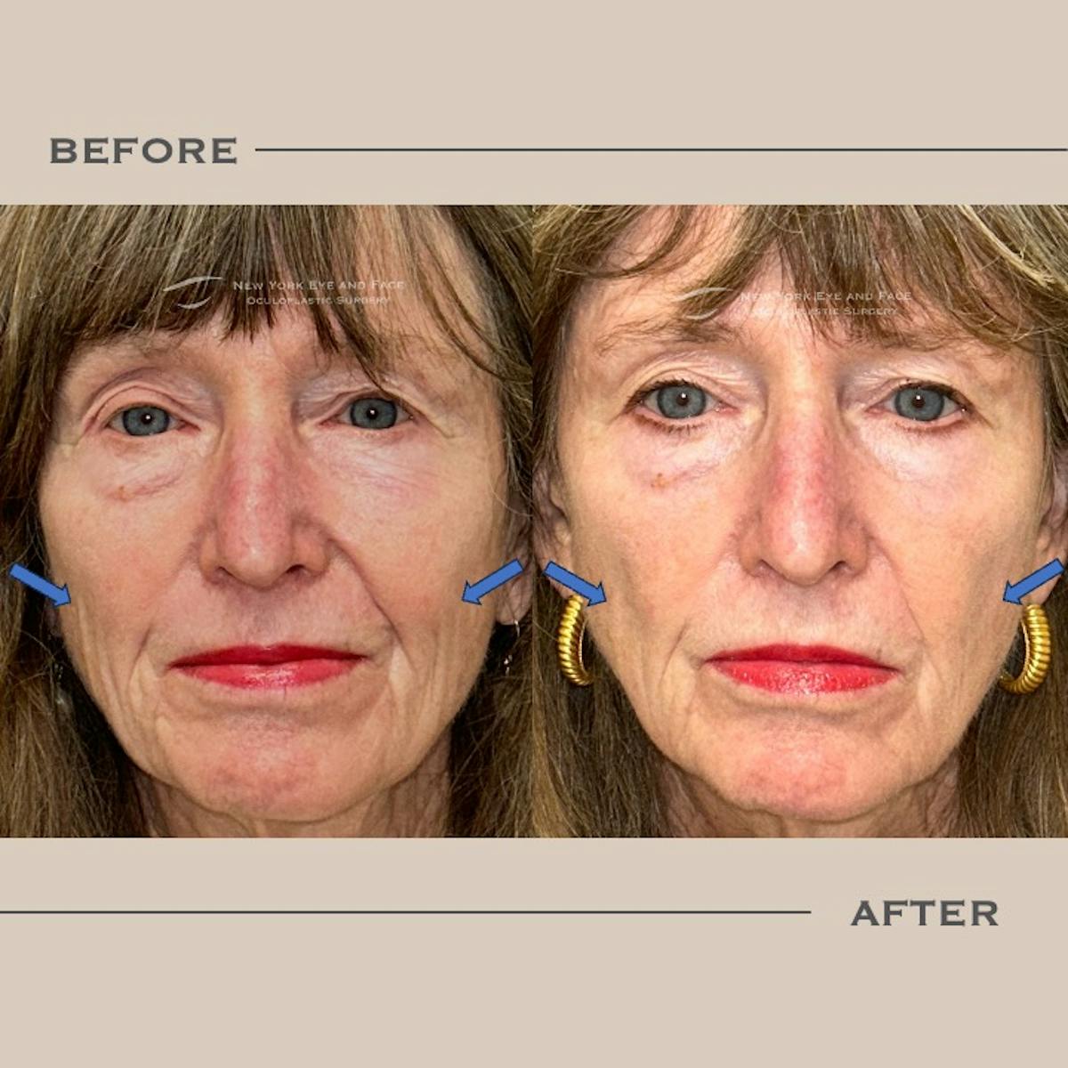 Sculptra Before & After Gallery - Patient 275988 - Image 1