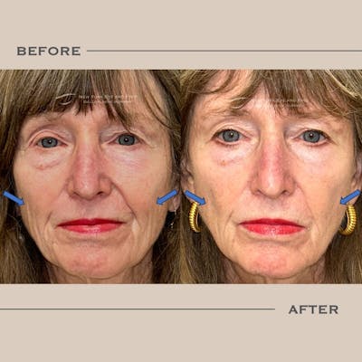 Sculptra Before & After Gallery - Patient 275988 - Image 1