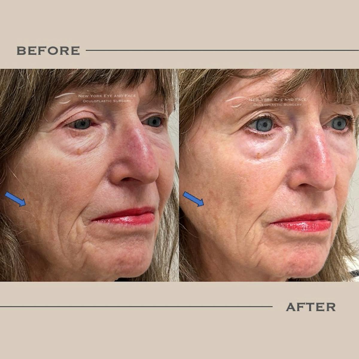 Sculptra Before & After Gallery - Patient 275988 - Image 2