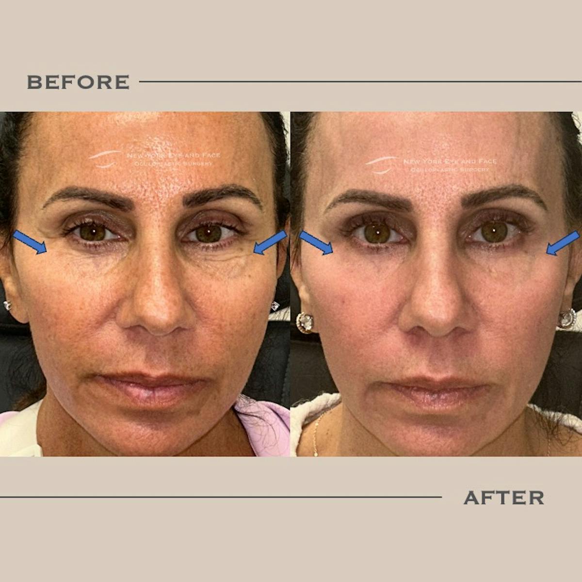 AcuPulse CO2 Laser Before & After Gallery - Patient 404480 - Image 1