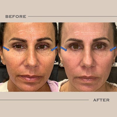AcuPulse CO2 Laser Before & After Gallery - Patient 404480 - Image 1