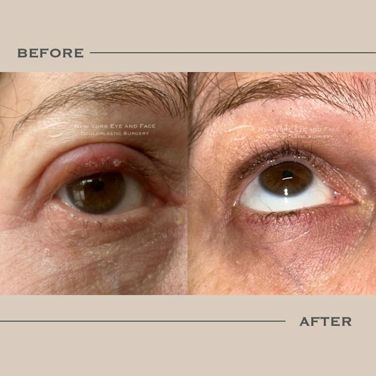 BroadBand Light (BBL) Before & After Gallery - Patient 210990 - Image 1