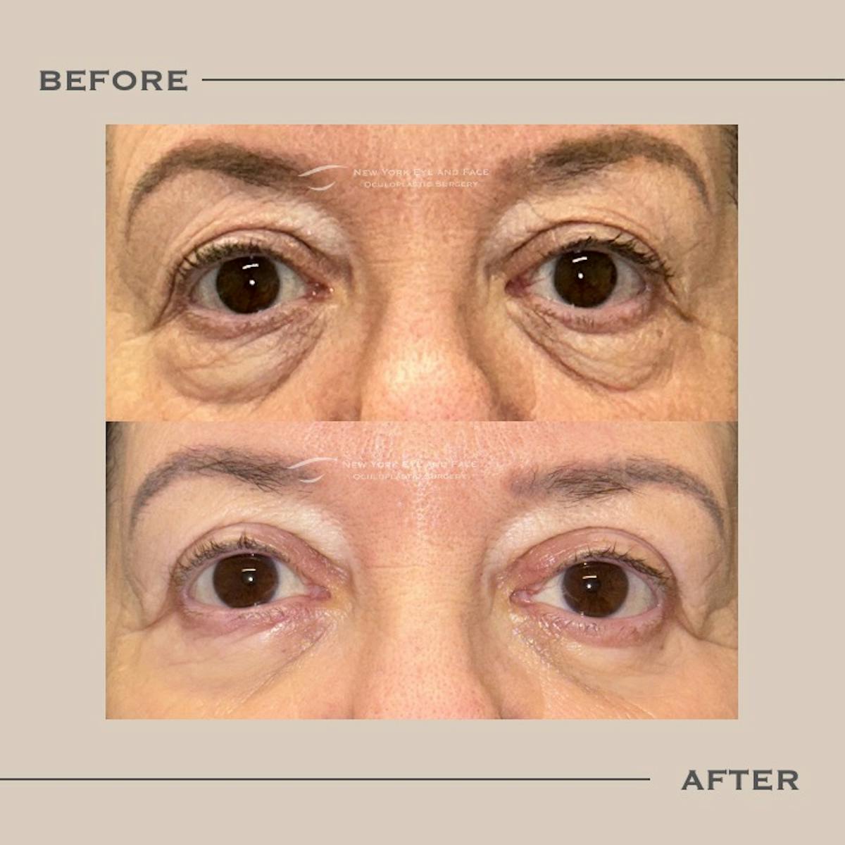 Lower Blepharoplasty Before & After Gallery - Patient 230215 - Image 1