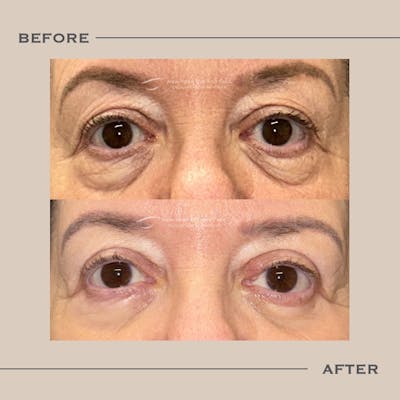 Upper Blepharoplasty Before & After Gallery - Patient 265049 - Image 1