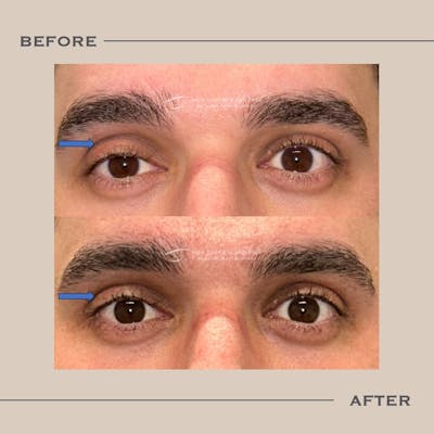 Ptosis  Before & After Gallery - Patient 219529 - Image 1