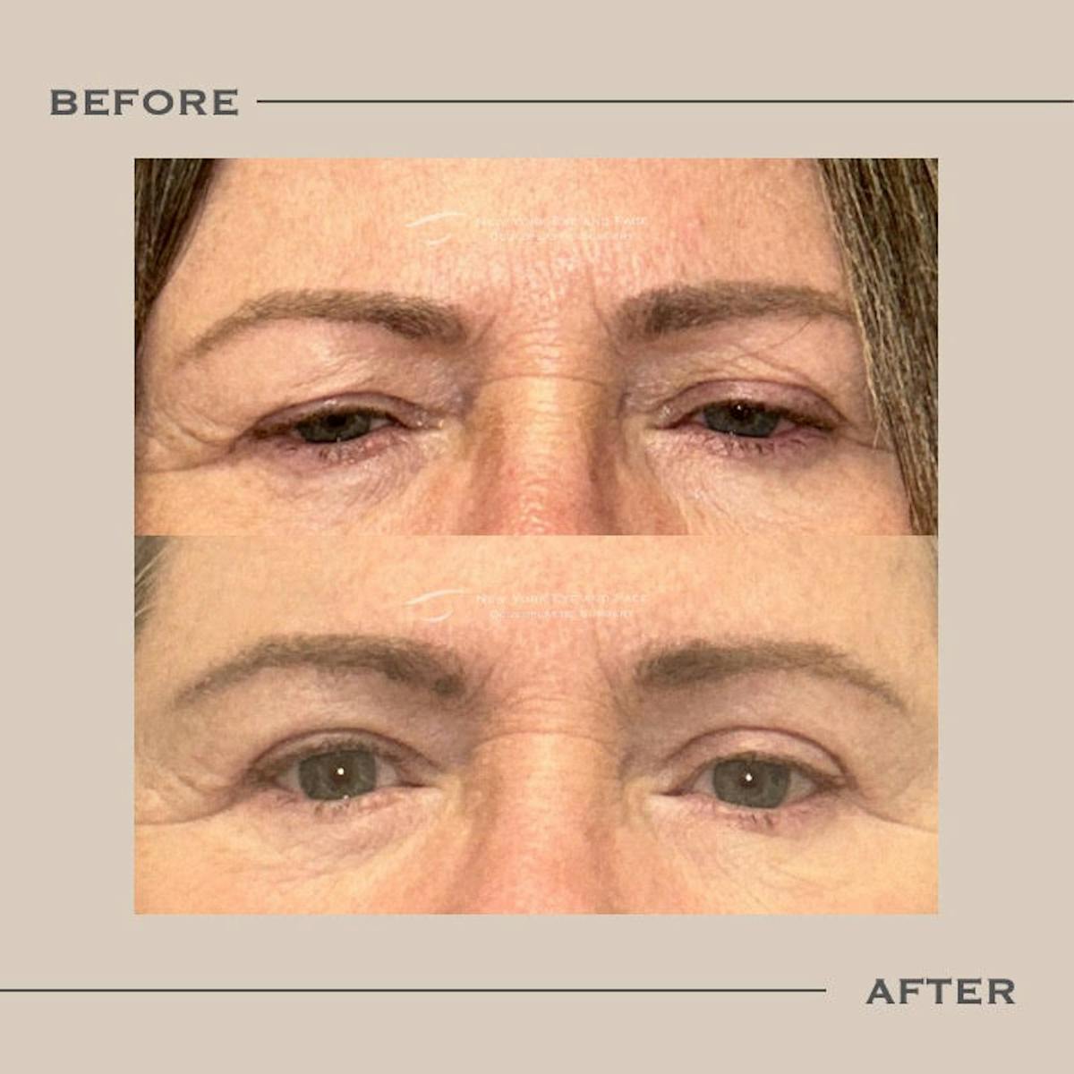 Upper Blepharoplasty Before & After Gallery - Patient 320153 - Image 1