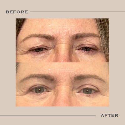 Upper Blepharoplasty Before & After Gallery - Patient 320153 - Image 1