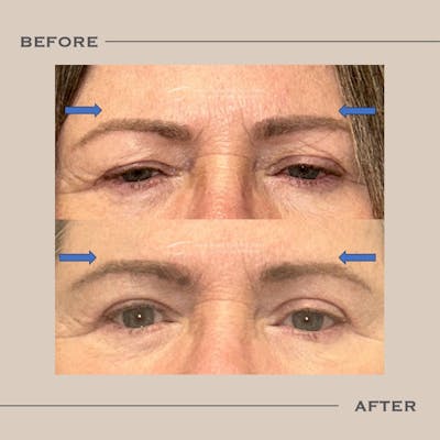 Brow Lift Before & After Gallery - Patient 352980 - Image 1