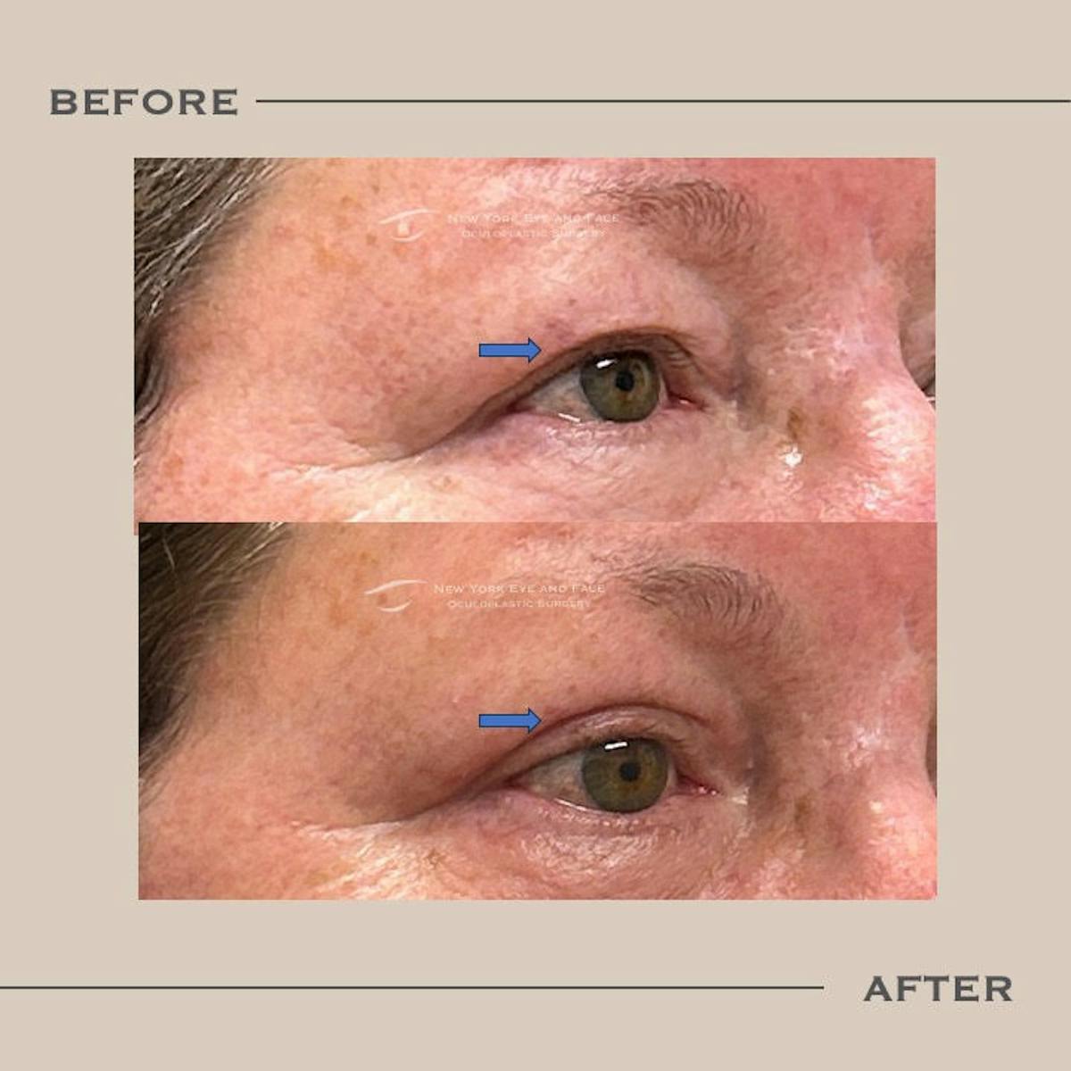Upper Blepharoplasty Before & After Gallery - Patient 349176 - Image 2