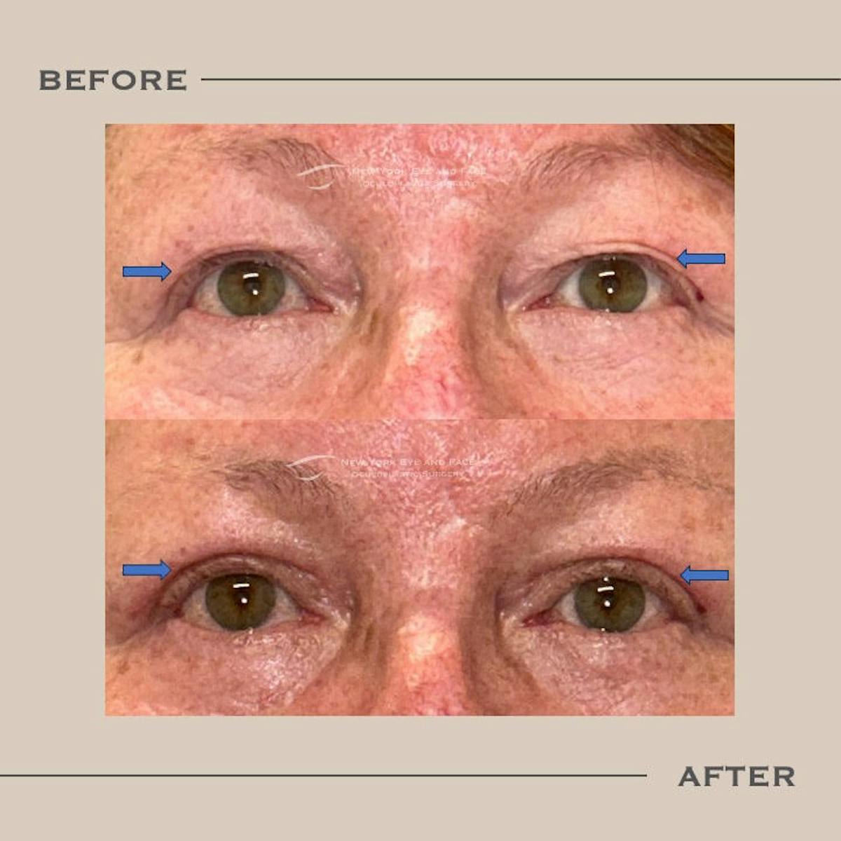 Upper Blepharoplasty Before & After Gallery - Patient 349176 - Image 1