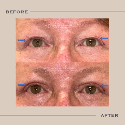 Upper Blepharoplasty Before & After Gallery - Patient 349176 - Image 1