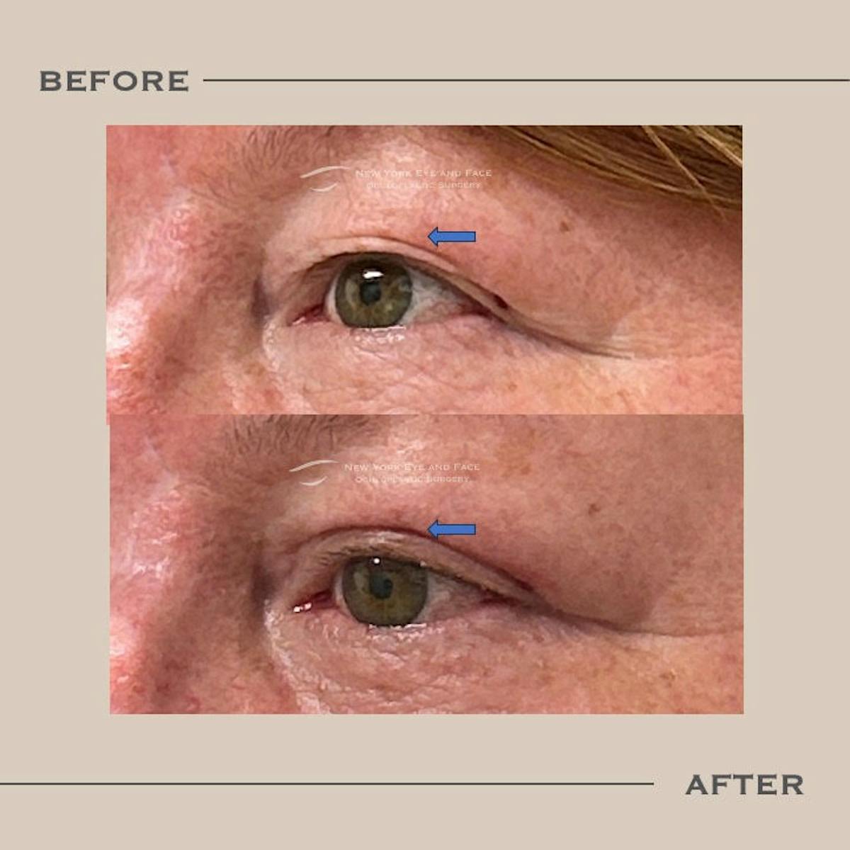 Upper Blepharoplasty Before & After Gallery - Patient 349176 - Image 3