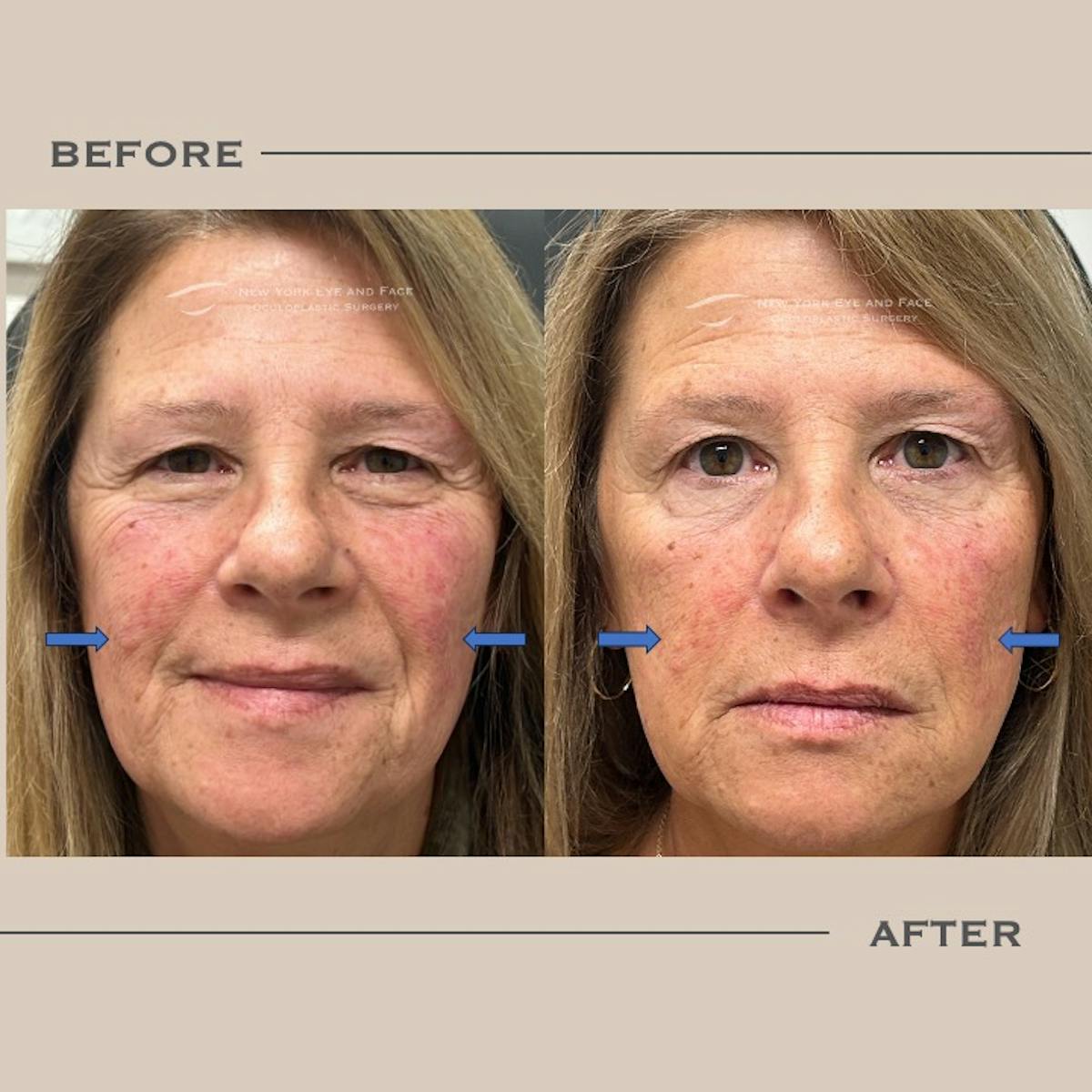 Sculptra Before & After Gallery - Patient 610646 - Image 1