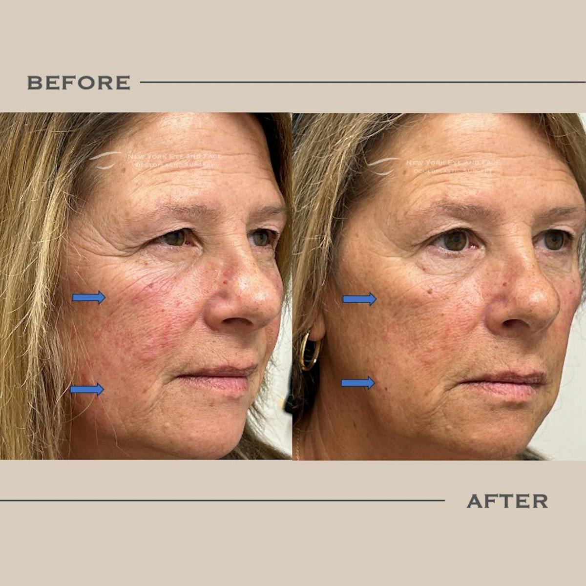 Sculptra Before & After Gallery - Patient 610646 - Image 2