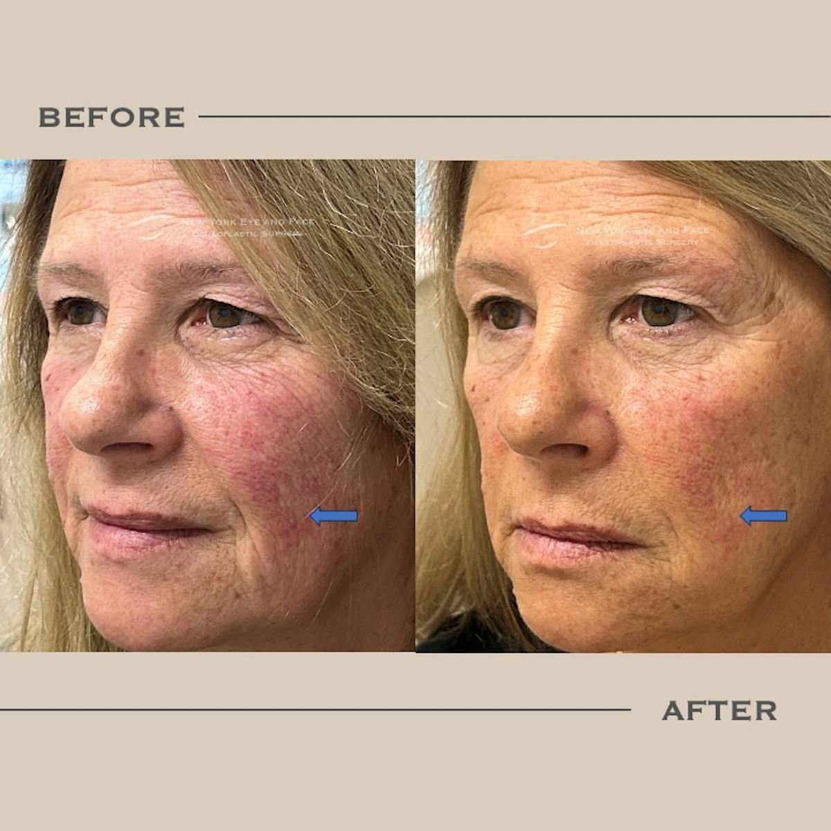 Sculptra Before & After Gallery - Patient 610646 - Image 3