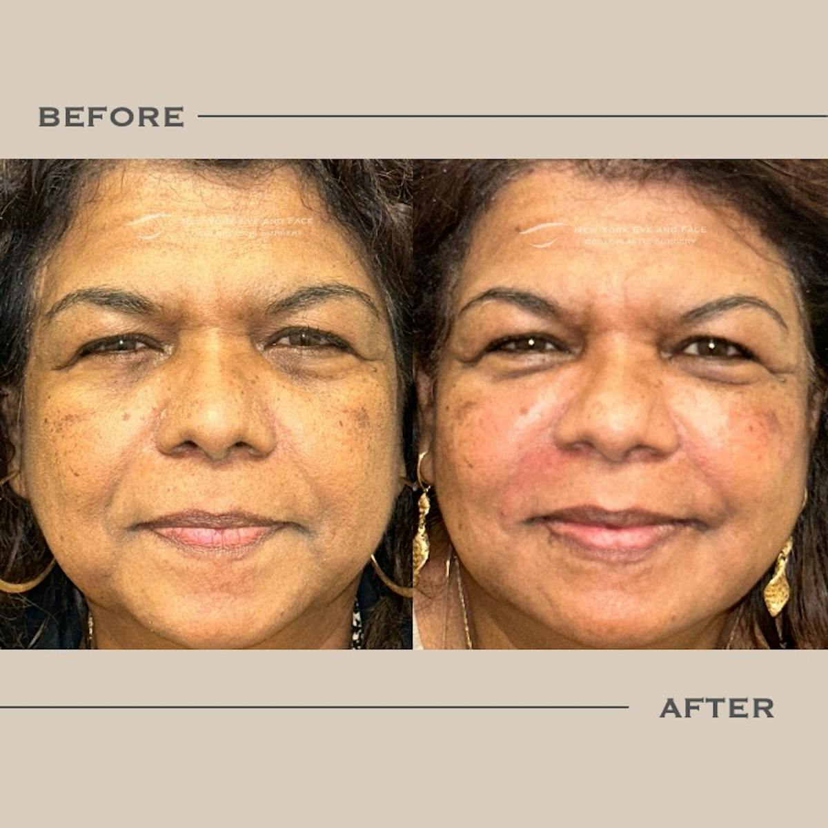 Dermal Fillers Before & After Gallery - Patient 891105 - Image 1